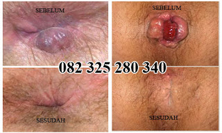 Illustration for article titled obat wasir